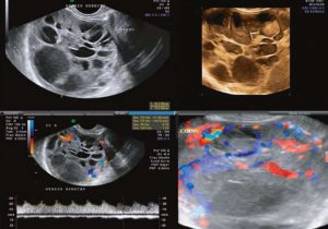 Figura 5. Ultrasonografía 2D, Doppler y 3D en tumor ovárico
