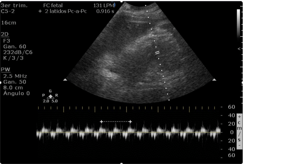 Ultrasonido en el tercer trimestre de embarazo mostrando la medición de la máxima columna vertical de líquido amniótico, con un resultado de 1.73 cm, indicativo de oligohidramnios severo.