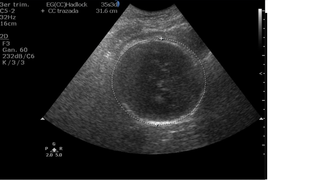 Ecografía en tercer trimestre que muestra la medición de la máxima columna vertical (MCV) del líquido amniótico, con resultado de 1.73 cm, indicando oligohidramnios severo.