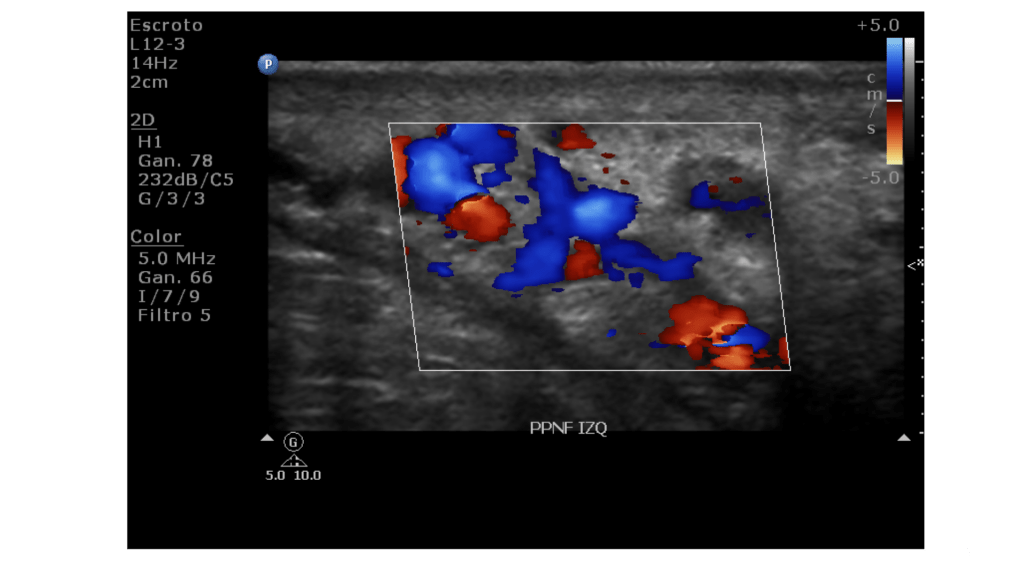 Ecografía escrotal que muestra áreas en color azul y rojo, indicando diferentes flujos sanguíneos en la imagen.