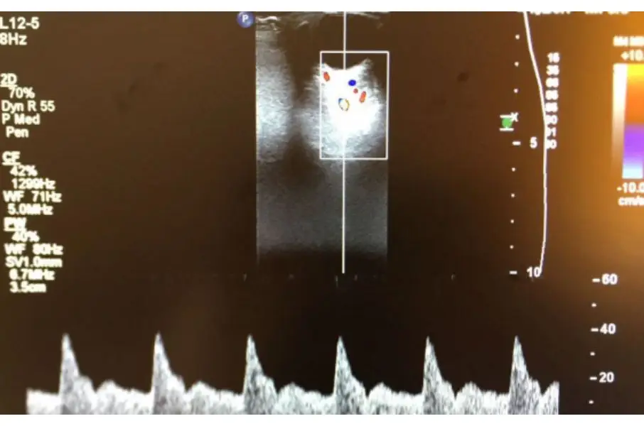 ARTERIA OFTÁLMICA EN EL EMBARAZO: DOPPLER PARA PREDICCIÓN DE PRECLAMSIA